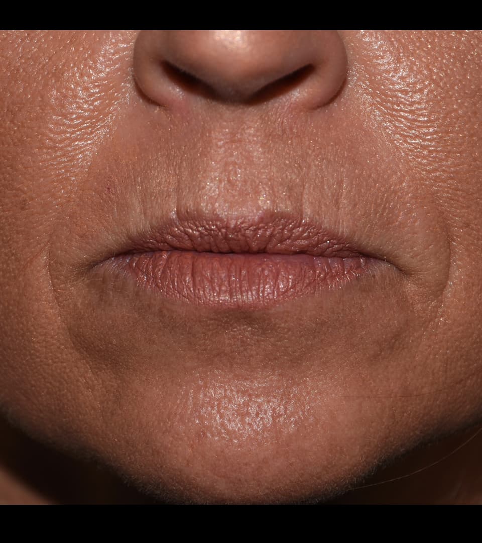 Juvéderm, perioral lines, before