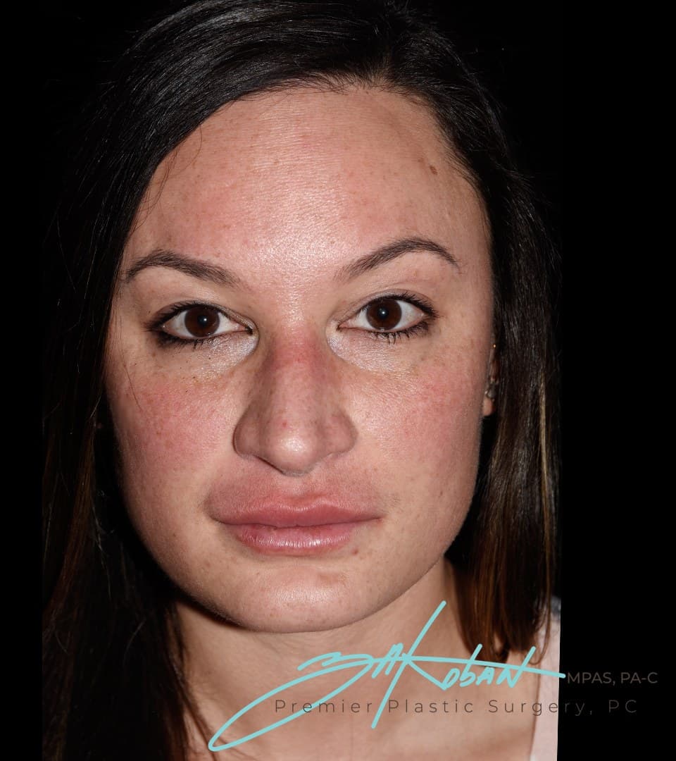 Whole face, subtle lip, after