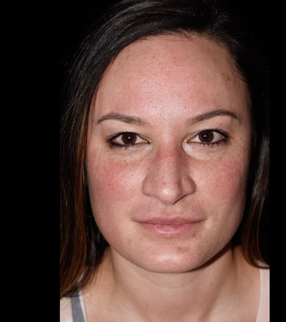 Whole face, subtle lip, before