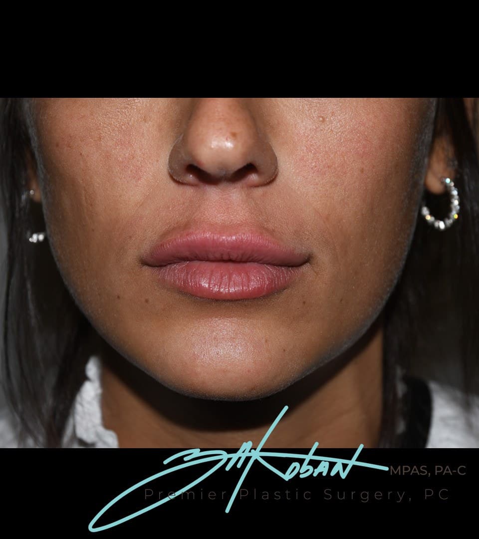 Upper lip balance, after