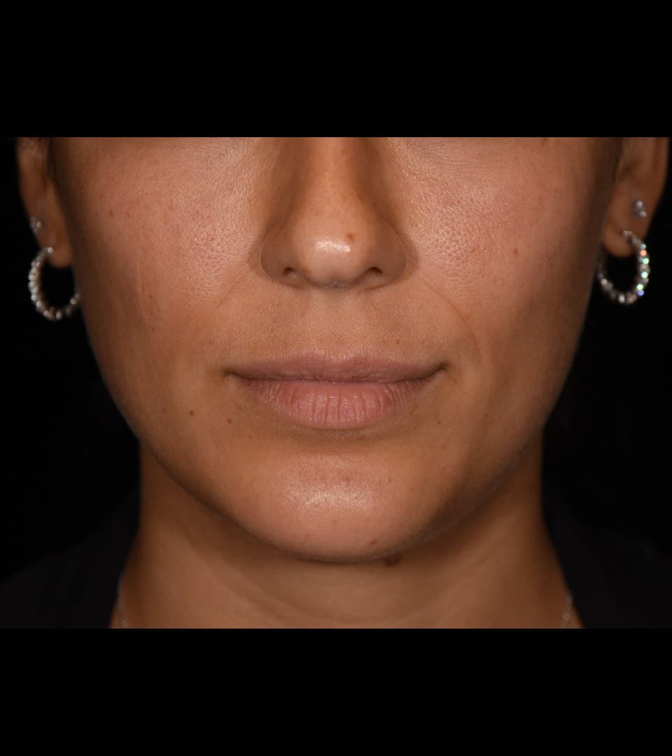 Upper lip balance, before