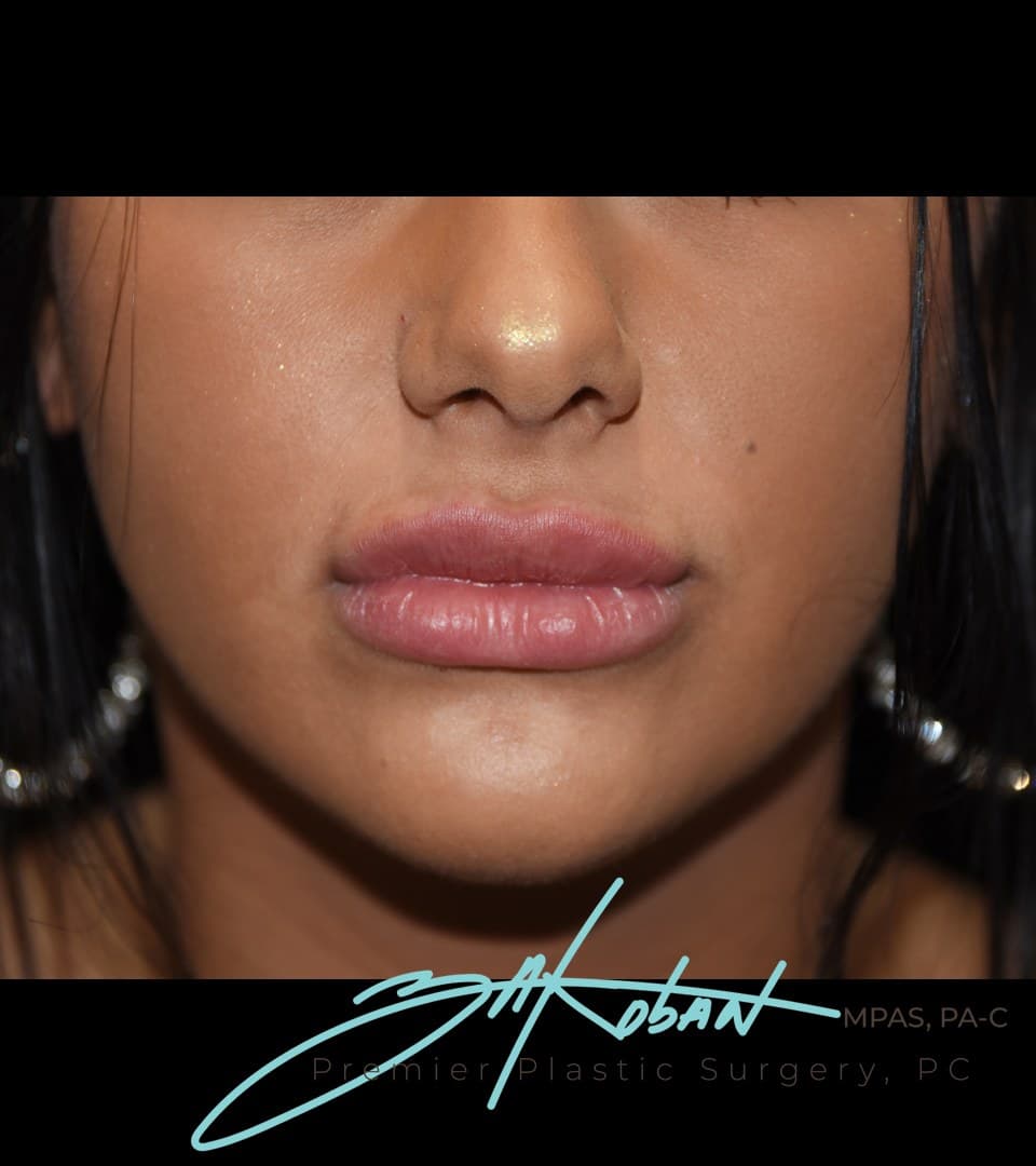 Volume through both lips, after