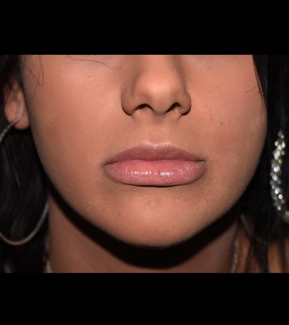 Volume through both lips, before