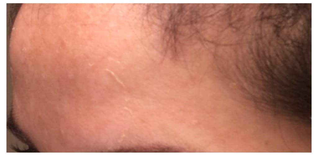 Forehead pigment, after