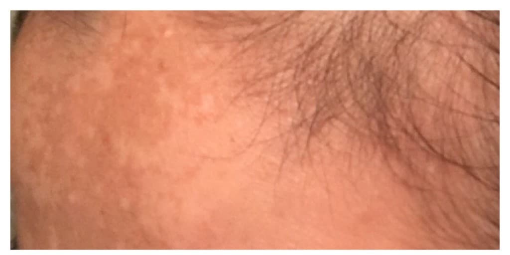 Forehead pigment, before