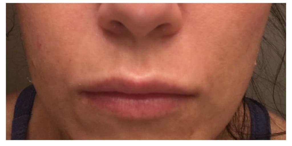 Around the mouth, after