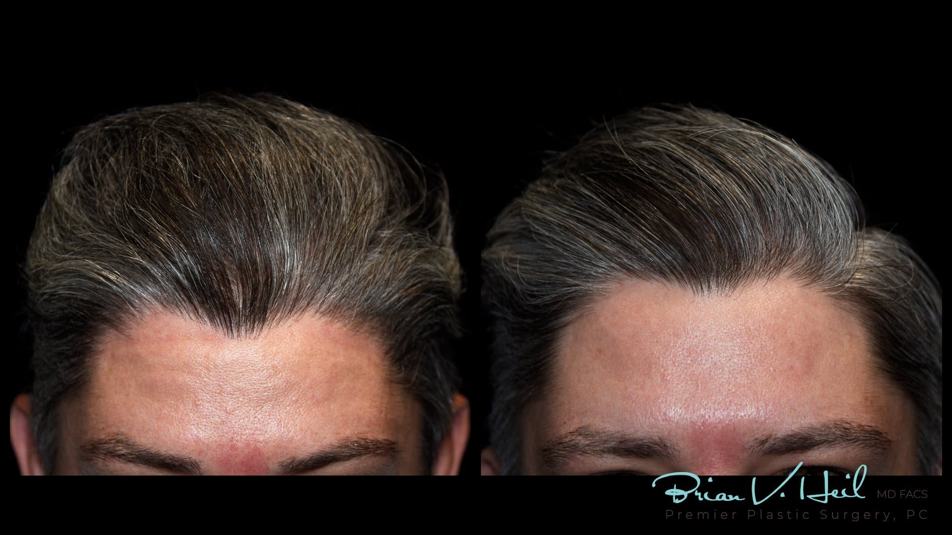 PRP Hair Therapy, Front hairline: before and after
