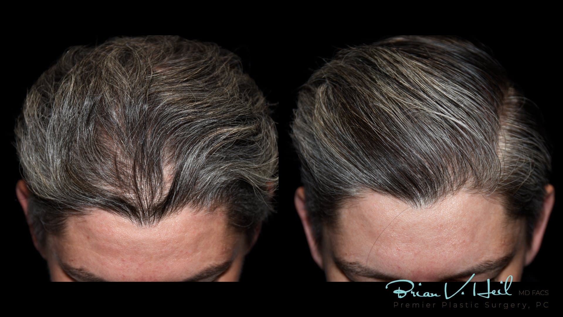 PRP hair therapy, crown, from above: before and after
