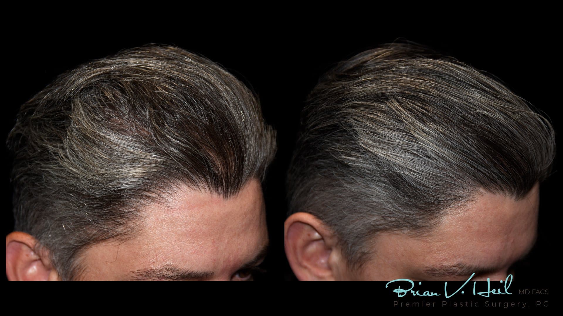 PRP Hair Therapy, Left side: before and after