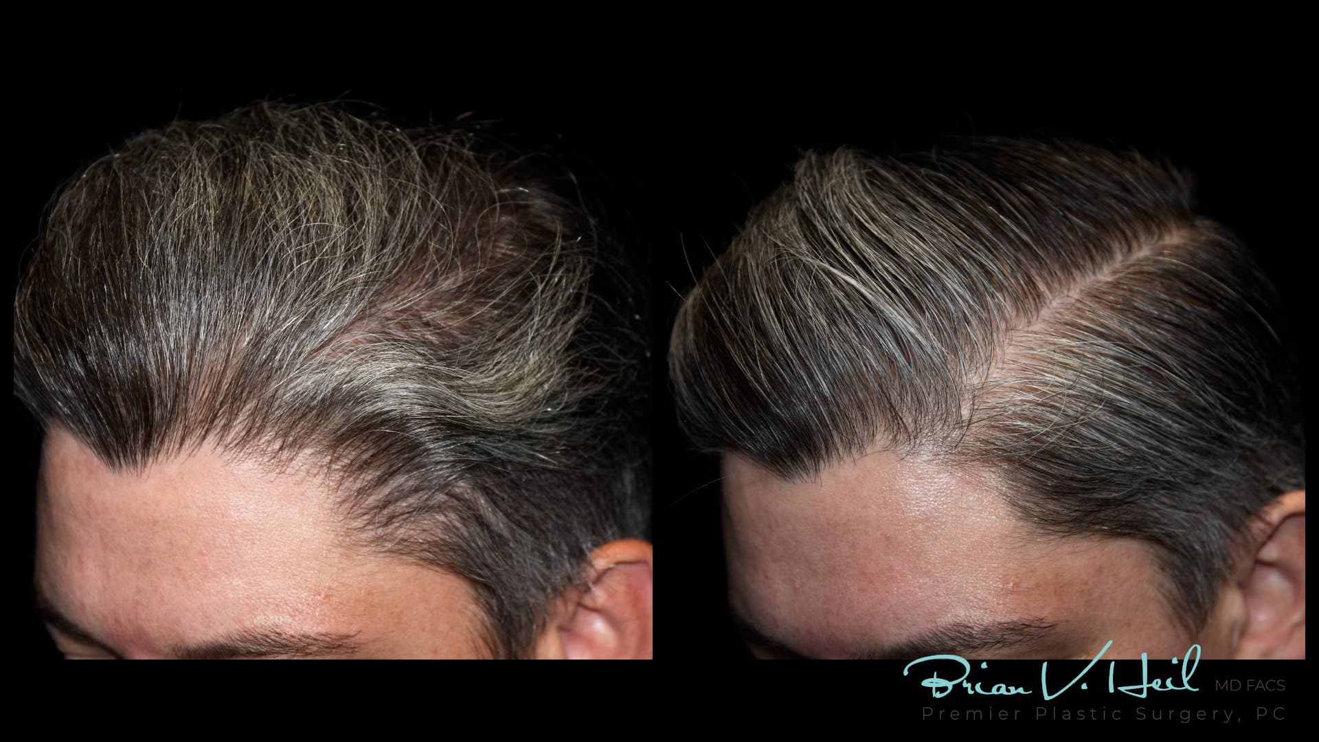 PRP hair therapy, right side: before and after