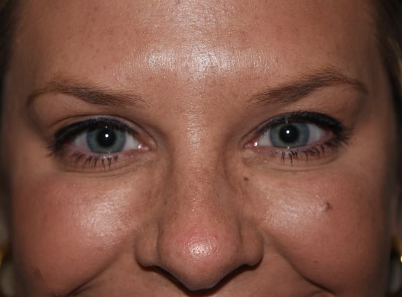 Restylane, under the eyes, after