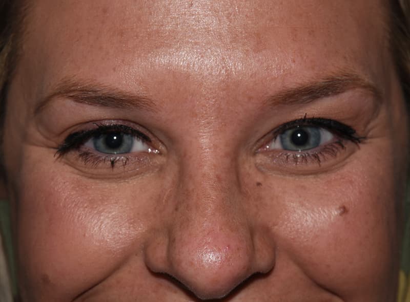 Restylane, under the eyes, before