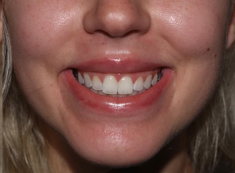 Restylane, smile lines, after