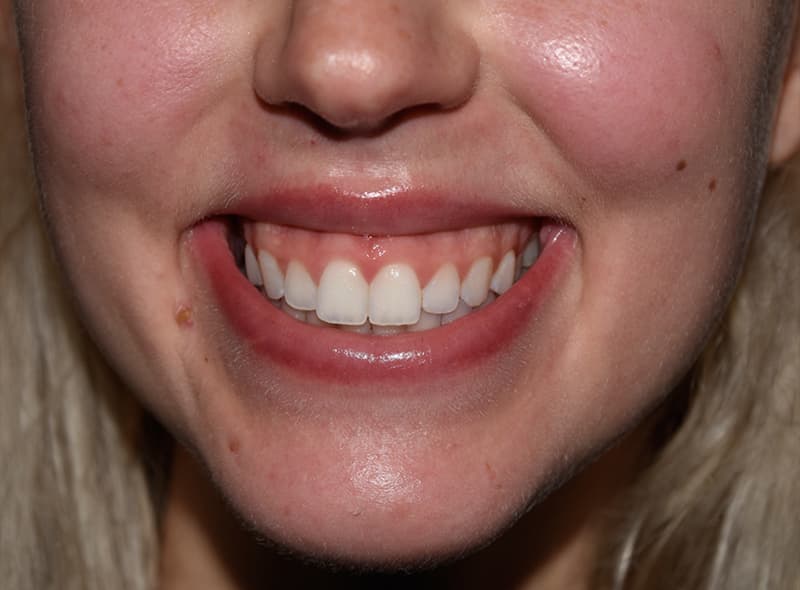 Restylane, smile lines, before