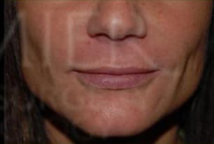 Restylane, nasolabial folds, after