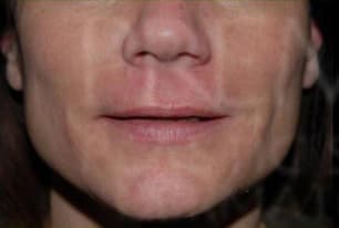 Restylane, nasolabial folds, before