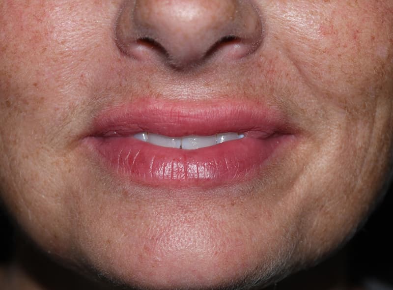 Restylane, around the mouth, after