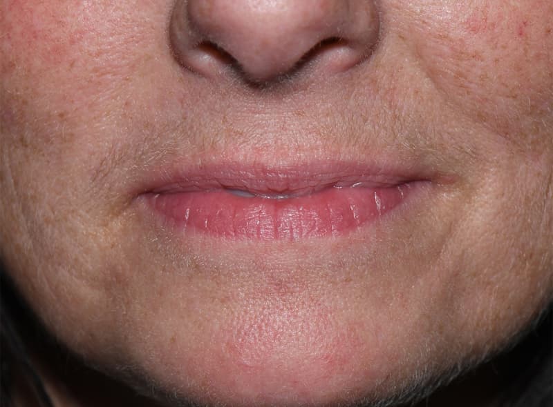 Restylane, around the mouth, before