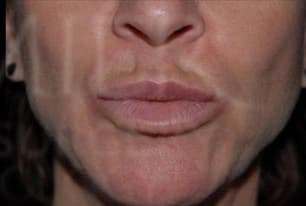 Refyne & Defyne, perioral lines, after