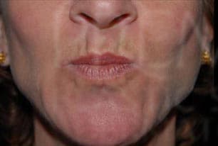 Refyne & Defyne, perioral lines, before