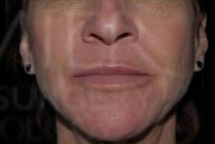 Refyne & Defyne, nasolabial folds, after