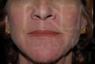 Refyne & Defyne, nasolabial folds, before