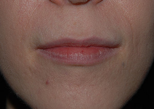 Botox