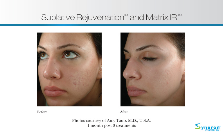 Facial Rejuvenation in Pittsburgh