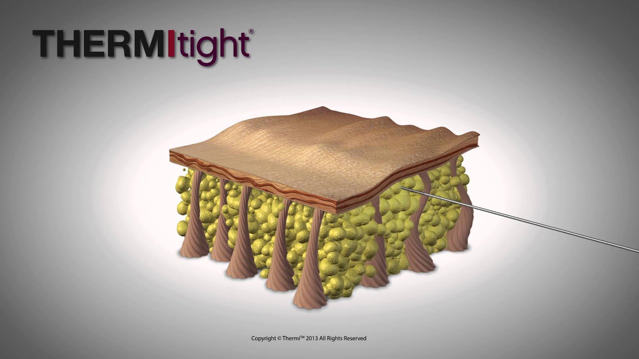 Thermitight and Thermismooth Procedure