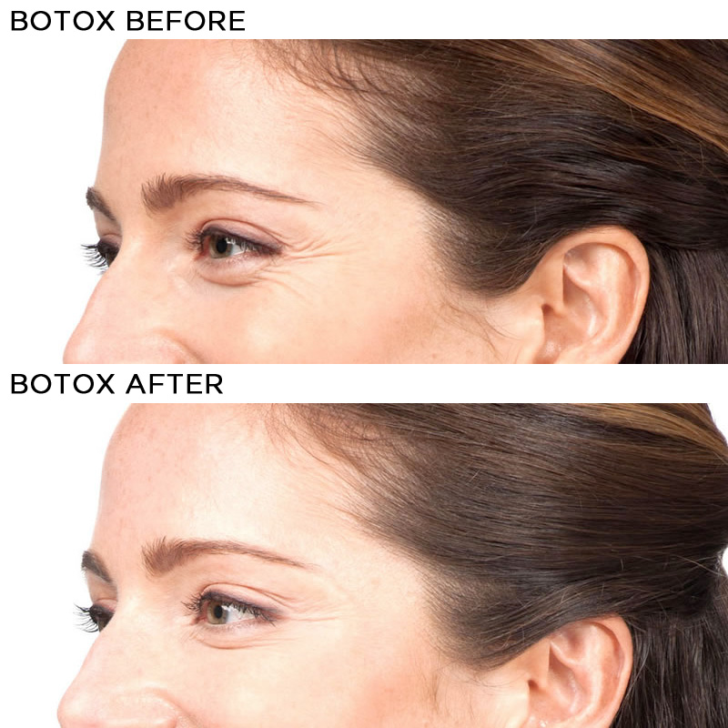 BOTOX-BA