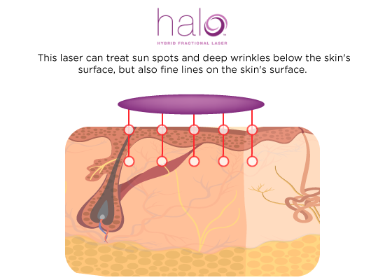 halo-laser