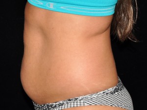 CoolSculpting in Pittsburgh