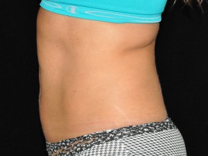 CoolSculpting in Pittsburgh