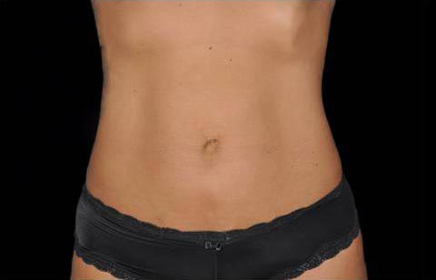 Coolsculpting Before and After | Acqua Blu Medical Spa