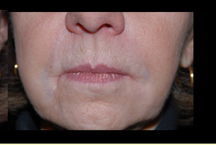 Fillers Before and After | Acqua Blu Medical Spa