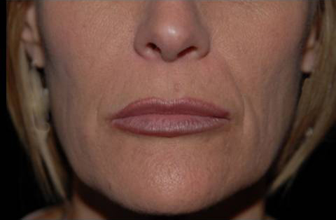 Fillers Before and After | Acqua Blu Medical Spa
