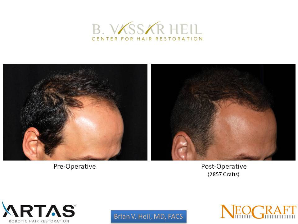 Hair Restoration Before and After | Acqua Blu Medical Spa