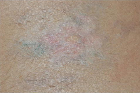 Laser Tattoo Removal Before and After | Acqua Blu Medical Spa