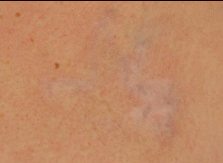 Laser Tattoo Removal Before and After | Acqua Blu Medical Spa