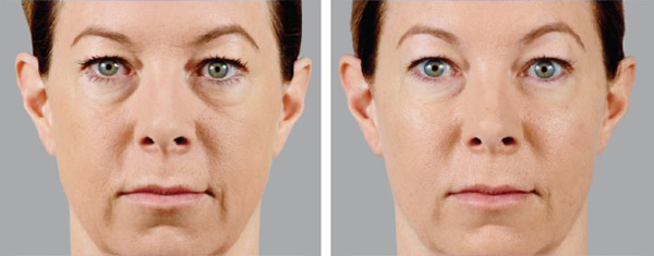Juvederm in Pittsburgh