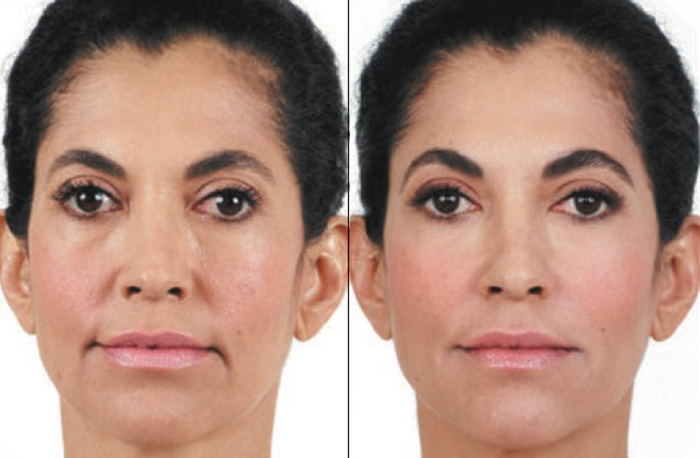 Juvederm in Pittsburgh