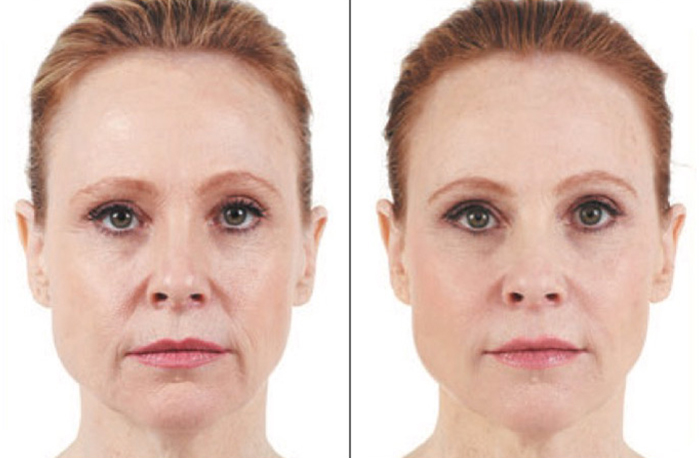 Juvederm in Pittsburgh