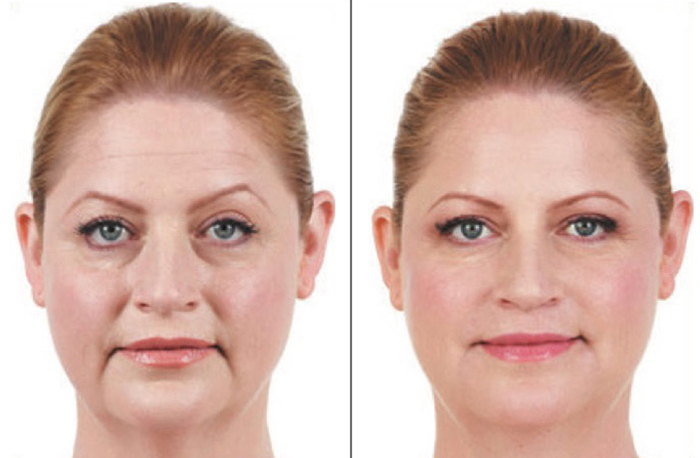 Juvederm in Pittsburgh