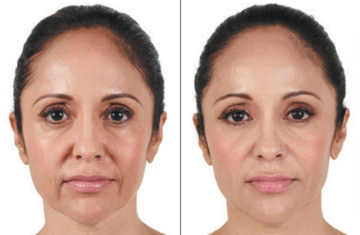 Juvederm in Pittsburgh