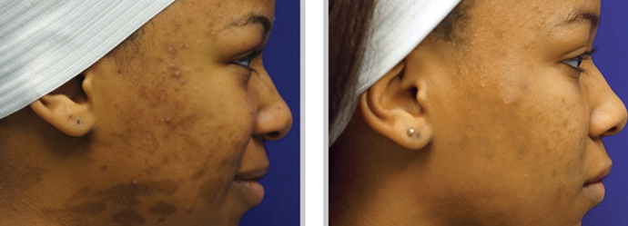 Laser Skin Resurfacing - Pittsburgh, PA