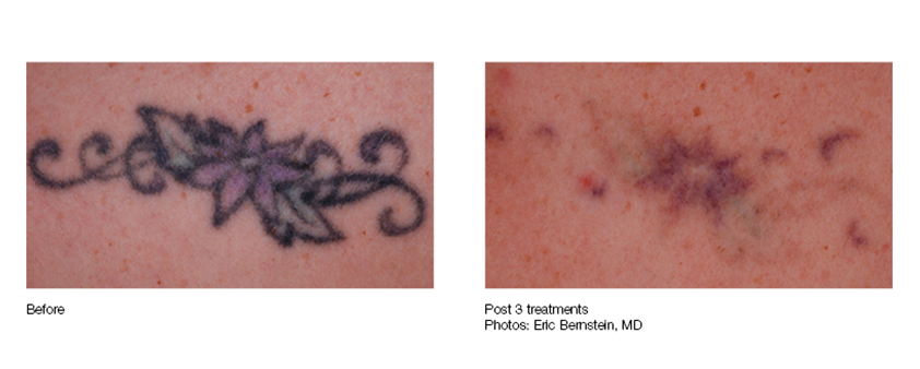 Delete Tattoo Removal  Laser Salon