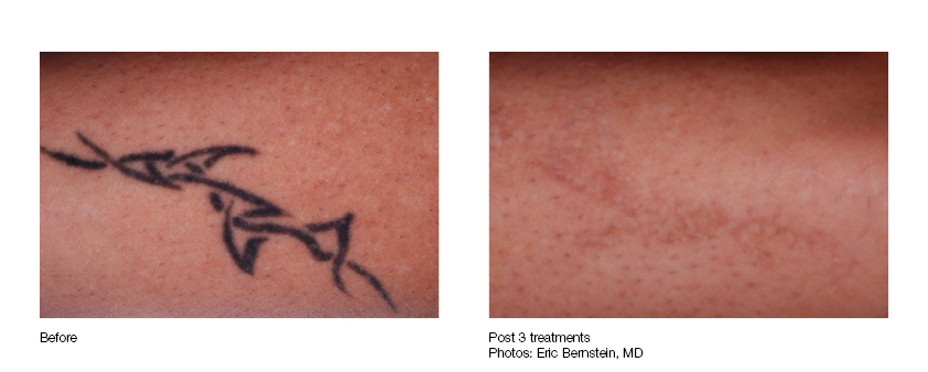 Laser Tattoo Removal in Pittsburgh & Wexford, PA