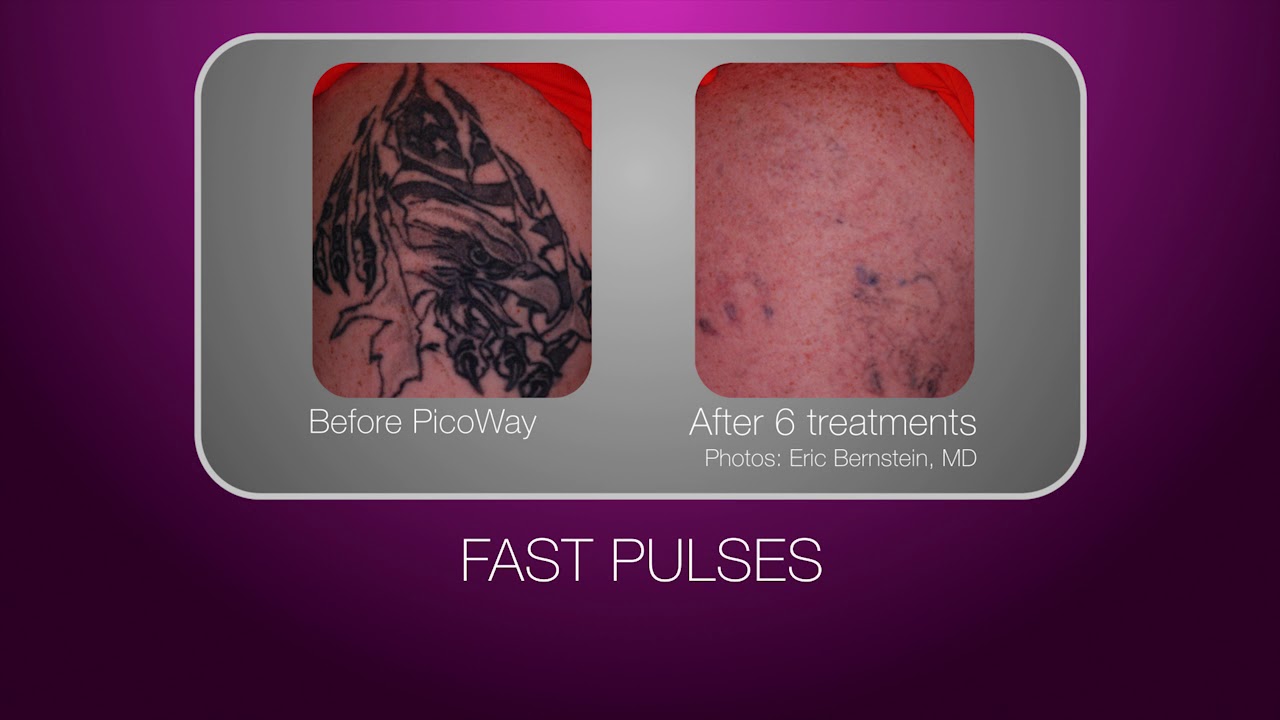 Laser Tattoo Removal in Pittsburgh, PA